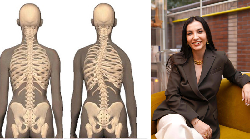 La Magie Clinic'te Üç Boyutlu Skolyoz Tedavisi