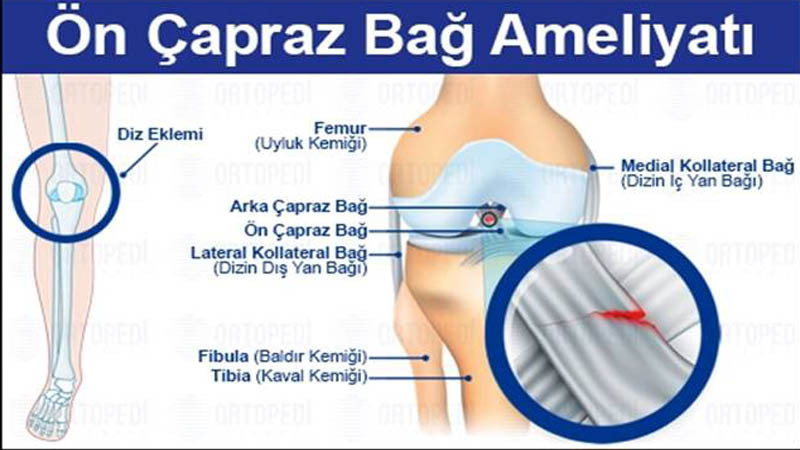 Ön Çapraz Bağ Kopması: Belirtiler, Tedavi ve Ameliyat Süreci